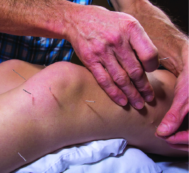 Dry Needling